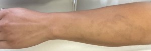 Laser Body Procedures
