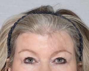 Eyelid Surgeries