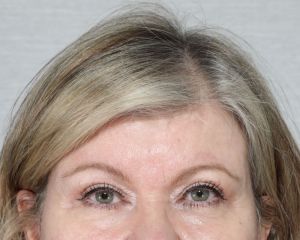 Eyelid Surgeries