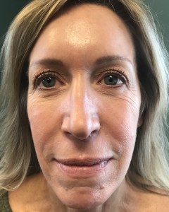 Fillers, Biostimulators