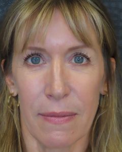 Fillers, Biostimulators
