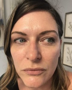 Fillers, Biostimulators