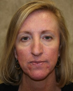 Fillers, Biostimulators