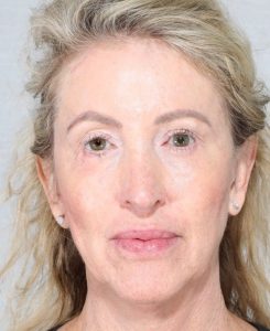 Fillers, Biostimulators