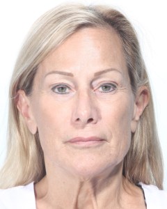 Fillers, Biostimulators