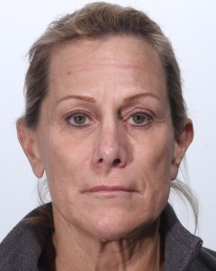 Fillers, Biostimulators