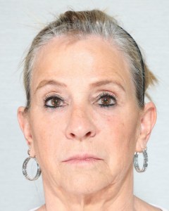 Fillers, Biostimulators
