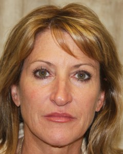 Fillers, Biostimulators