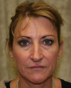 Fillers, Biostimulators