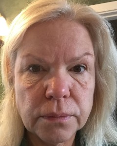 Fillers, Biostimulators