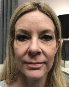 Fillers, Biostimulators
