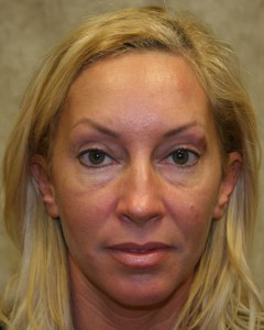 Fillers, Biostimulators