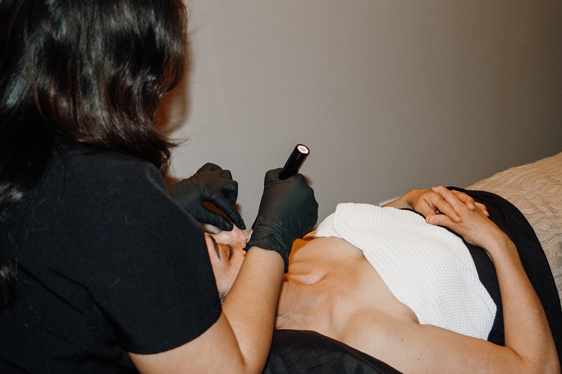 Microneedling treatment